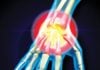 How occupational therapy can help people live with arthritis