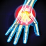 How occupational therapy can help people live with arthritis