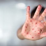 ‘Tough year’ for measles and other infectious diseases in US