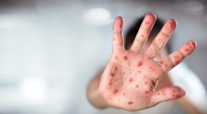‘Tough year’ for measles and other infectious diseases in US