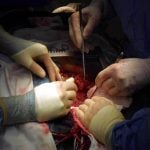 80 is not the new 70: Age may bias heart care, study finds surgery