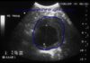 Health Right Here: What to expect with an abdominal aortic aneurysm ultrasound screening