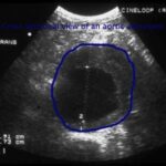 Health Right Here: What to expect with an abdominal aortic aneurysm ultrasound screening